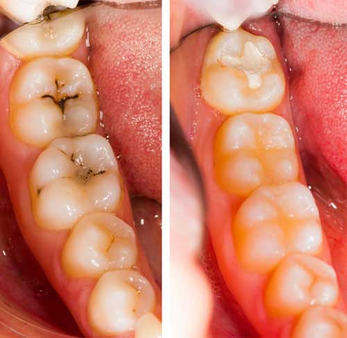 Dental Filling treatment