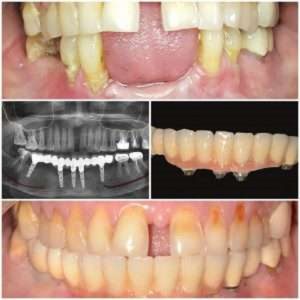 Implant Supported fixed crown treatment