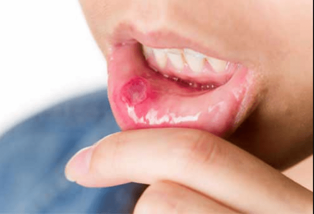 best Doctor for mouth Ulcer in nagpur